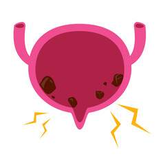 Bladder disease. Bladder stones illustration 