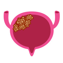Bladder disease. Bladder cancer illustration 