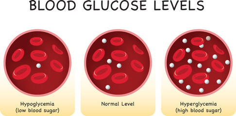 Glucose in the blood vessel. normal level, hyperglycemia (high blood sugar), hypoglycemia (low blood sugar). Vector illustration