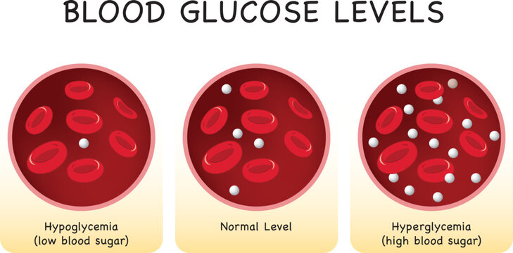 Glucose in the blood vessel. normal level, hyperglycemia (high blood sugar), hypoglycemia (low blood sugar). Vector illustration