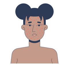 Black woman face with severe acne 2D vector illustration. Pimples, rosacea, pustules. African american female facial skin breakout flat character isolated on white background. Colorful cartoon image