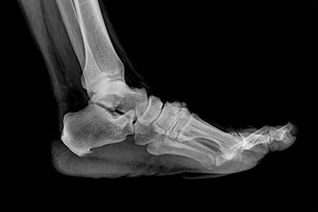 Latero-lateral X-ray of a valgus foot