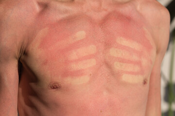 Dangerous sunburn  