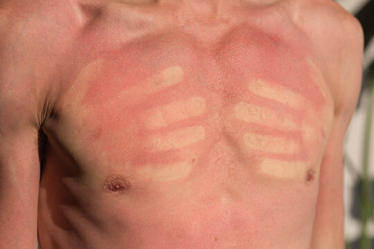 Dangerous sunburn  