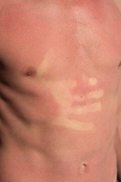Strong sunburn