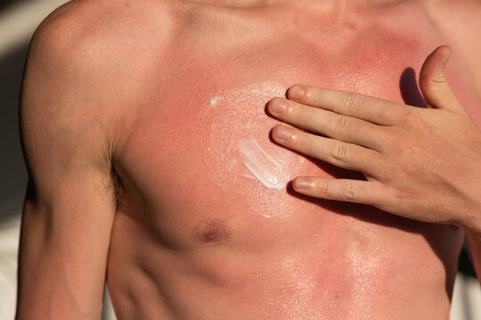 Man using sunburn aftercare cream