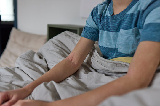 Child's arms and legs with eczema