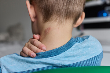 Little boy uses humidifier in his room to ease eczema