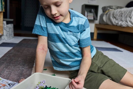 Little boy with eczema lays on a rug