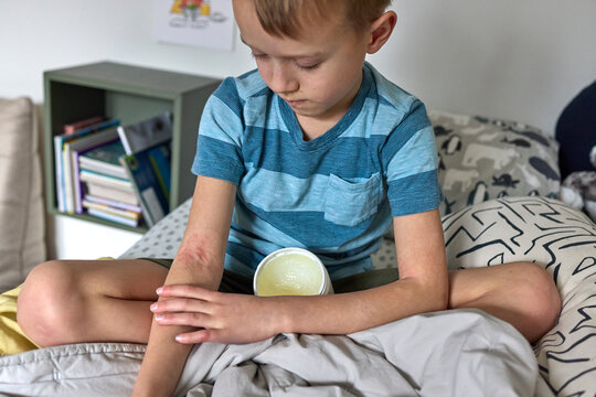 Little boy with eczema applying cream