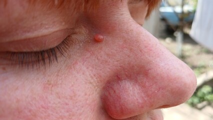 Obraz premium Papilloma on the face around the nose and eyes
