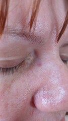 Naklejka premium Spot on the face after removal of papilloma (a week ago)