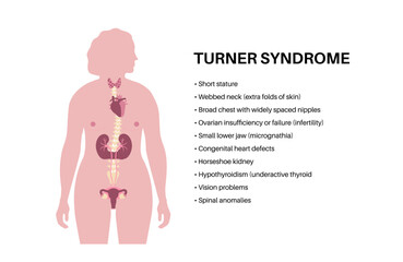Turner syndrome poster
