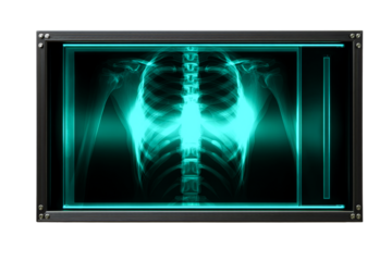 X ray image of thoracic region showing ribs and spine details