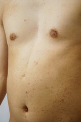 お腹　じんましん　湿疹