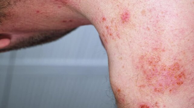 Skin lesion symptom in Shingles or Herpes zoster in person. Viral disease Varicella virus. Painful skin rash with blisters on the body. Red pimples. Insects bite. Body injury. High quality 4k footage.