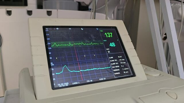 This video shows the screen of a fetal monitor displaying real-time fetal heart rate and uterine contraction tracings. The fetal heart rate is indicated as "137" and uterine activity as "48". 4k,video