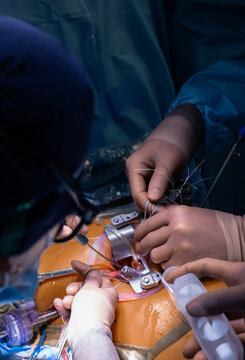 Team of surgeons minimally invasive mitral valve surgery repair. View of mitral annulus implantation by surgeons' hands in brown gloves on a blue background of gowns. Healthcare. High quality photo
