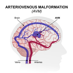 Fototapeta premium Arteriovenous Malformation (AVM) Brain Illustration