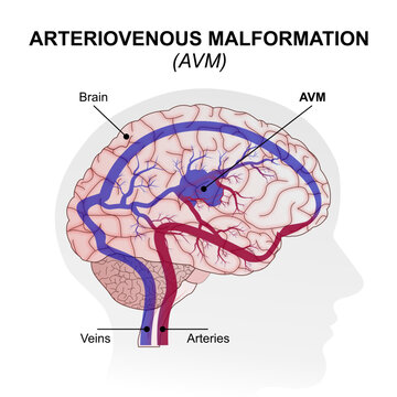 Arteriovenous Malformation (AVM) Brain Illustration