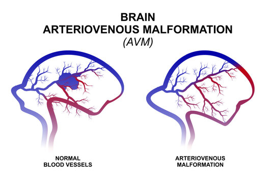 Brain Arteriovenous Malformation (AVM) Illustraion