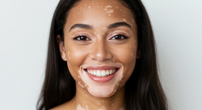 Close up of a smiling woman with vitiligo showing a positive and confident expression on a white background