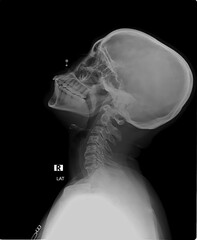 .Lateral Cervical Spine and Skull X-ray Right Side View