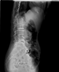 A black and white x-ray of a person's back and pelvis. The image is of a person's spine and pelvis