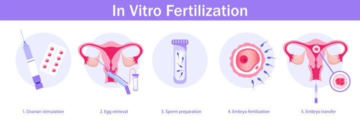 Fototapeta premium In vitro fertilization. Medical poster with Embryo development stages and transfer. Infographic on Purple Background