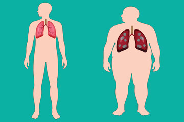 Comparison of healthy lungs and lung cancer in obese and normal male body.