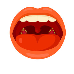 Tonsillitis (Tonsil Infection)