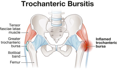 Trochanteric Bursitis. Hip Pain. Inflammation. Bursa. Labeled Illustration - obrazy, fototapety, plakaty