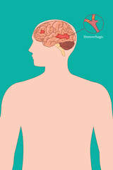 Medical illustration of hemorrhagic stroke in human brain, side view anatomy diagram