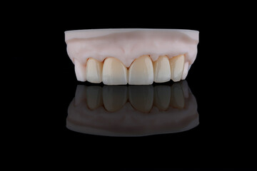 High-quality five dental crowns made of zirconium for fixation to the frontal teeth of upper jaw.
