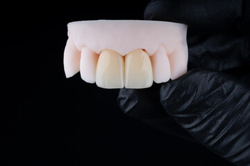 High-quality dental single crowns made of zirconium for fixation to the frontal teeth of upper jaw. © gorynvd