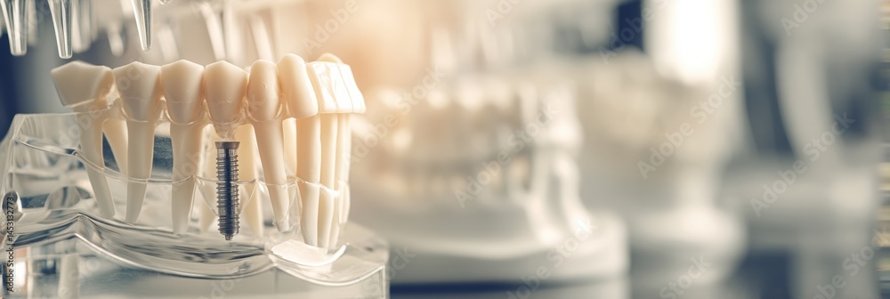 Aufkleber 3d printed jaw model with removable implant crown illuminated in dental clinic setting displaying ad