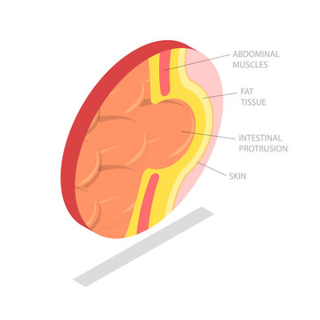3D Isometric Flat  Illustration of Hernia, Health Issues Related To The Abdomen And Intestines