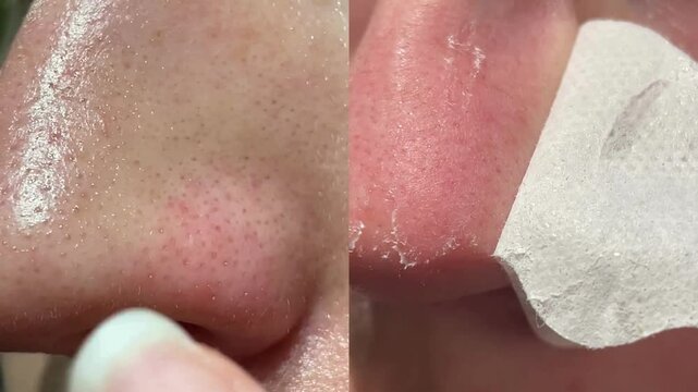 Close-up comparison of nose skin before and after blackhead removal using a pore strip. Visible skin texture improvement and cleaner pores. Concept of skincare and facial hygiene.