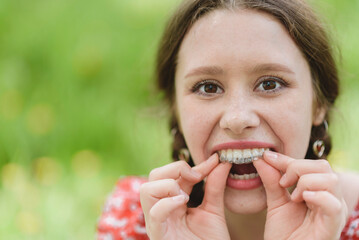 Dental care. Smiling girl putting on aligners. Plastic retainers for teeth alignment.