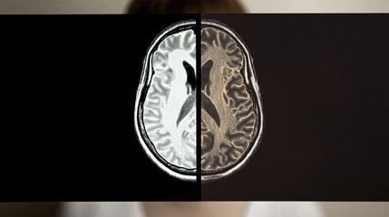 Axial MRI section of a human brain post-processed with colors showing the gray matter, white matter, ventricles and calvaria.