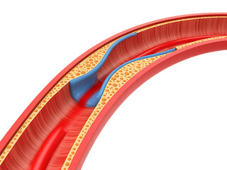 Obraz premium Detailed illustration of a human artery depicting blood flow and a possible blockage