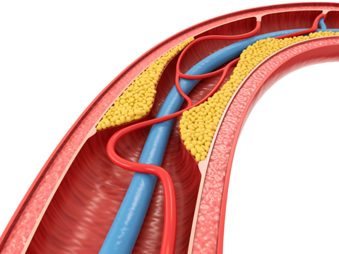 Medical 3d illustration showing arteriosclerosis and plaque build up obstructing blood flow