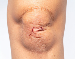 Fototapeta premium A scraped knee shows minor skin damage.