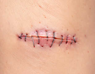 A stitched incision shows surgical healing progress.