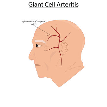 Giant cell arteritis vector illustration