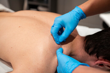 Physiotherapist uses dry needling technique to treat muscle pain and tension