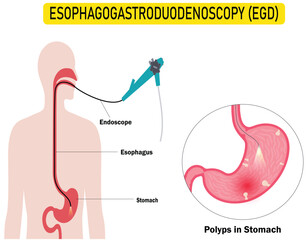 esophagogastroduodenoscopy medical procedure for Diagnosing Stomach and Duodenum Conditions