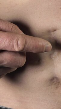 Vertical video of man apply treatment cream on ugly bad an indented scar on his belly after the appendicitis surgery. Old keloid scar on the stomach. Close up, 4k footage.