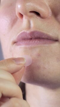 Vertical video of woman applying anti acne master pimple patch with hydrocolloid dressing. Close up, 4k footage.