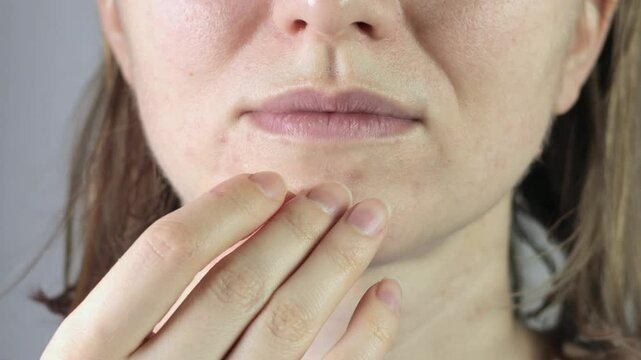 Woman applying anti acne master pimple patch with hydrocolloid dressing. Close up, 4k footage.